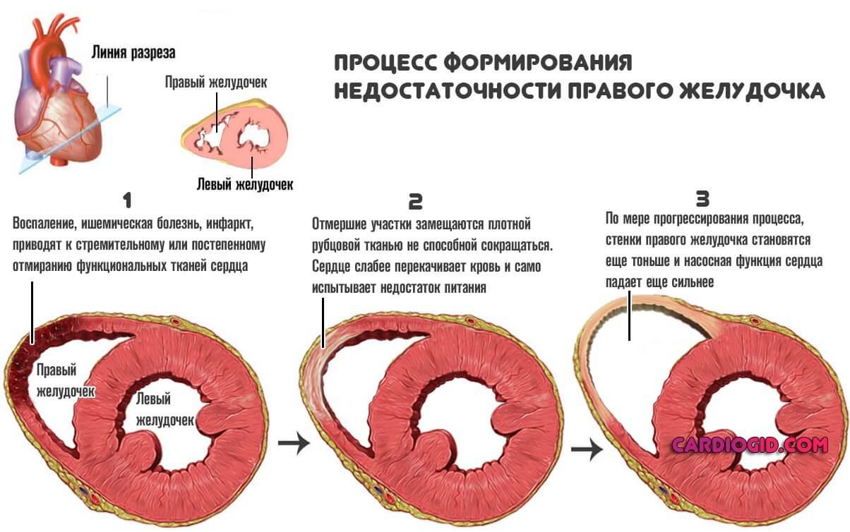 Острая правожелудочковая сердечная недостаточность презентация