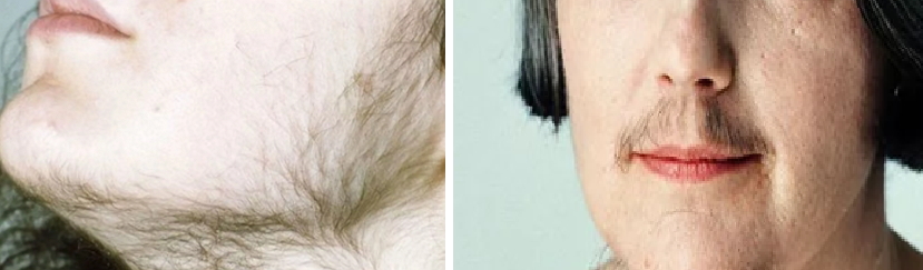 Влияет ли тестостерон на рост волос на лице