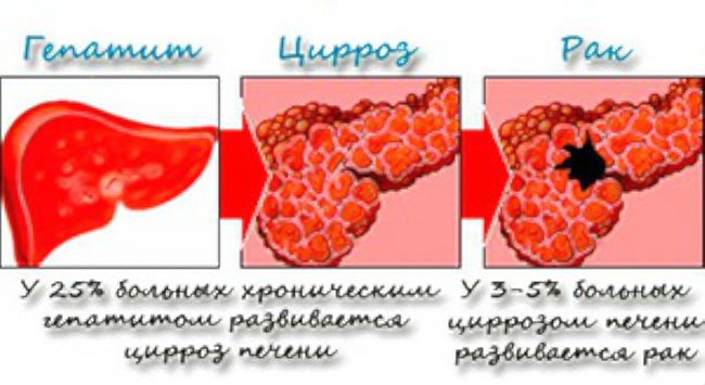 Рак печени 4 стадии сколько живут. Цирроз печени это онкология. Раковые поражения печени.